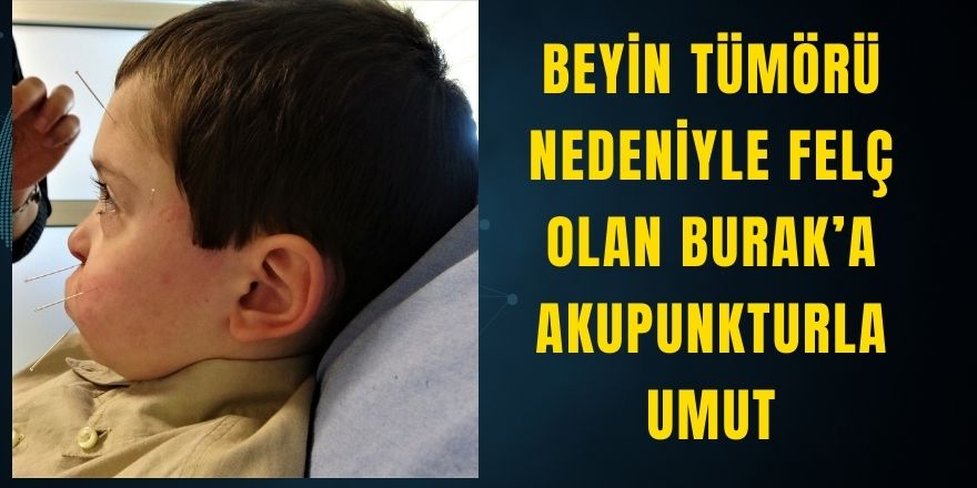 Beyin Tümörü Nedeniyle Felç Olan Burak’a Akupunkturla Umut